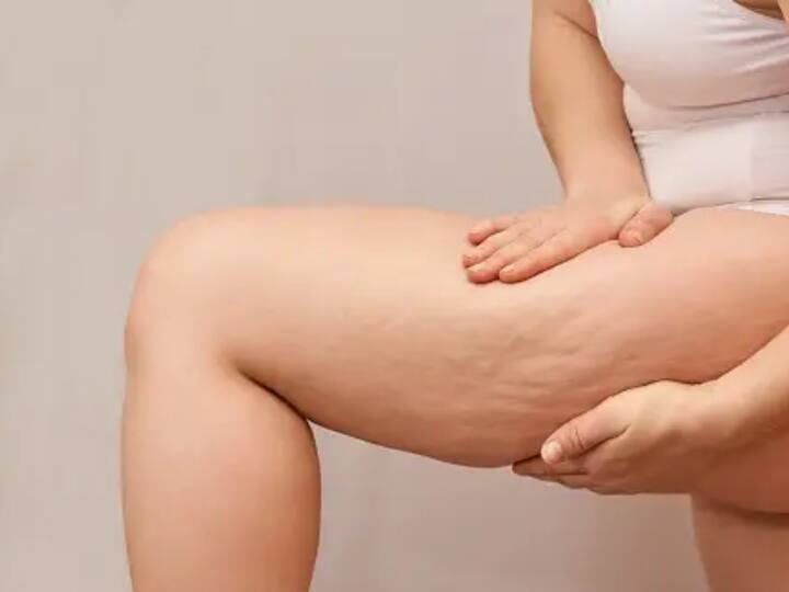 Cellulite Home Remedy: கொழுப்பு திசுக்களை வீட்டில் இருந்தபடியே குறைக்க சிம்பிளான ஹோம் ரெமடி இதோ..