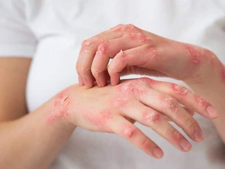 Psoriasis is a skin disease that causes a rash with itchy scaly patches किन लोगों को होता हैं सोराइसिस का डर, ये हैं इसके शुरुआती लक्षण...ऐसे करें बचाव