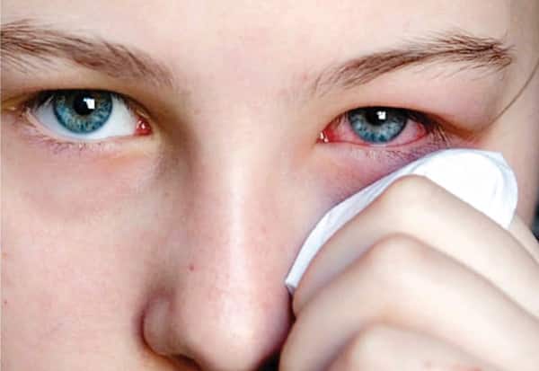 what is eye flu and its types know some tips from expert to prevent pink eye or conjunctivitis Eye Flu:'આઈ ફ્લૂ' એક જ પ્રકારનો નથી, નિષ્ણાતો પાસેથી જાણો કયો છે સૌથી ખતરનાક
