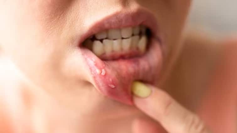 Signs And Symptoms Of Oral Cancer Know In Detail Health Tips News Marathi Oral Cancer : तोंडाच्या Cancerची लक्षणे कोणती? ती कशी ओळखायची? वाचा सविस्तर