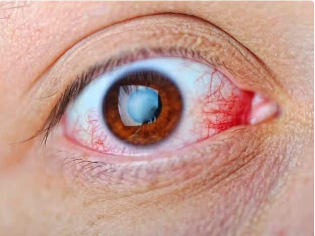 These 5 dangerous diseases of the eyes, due to which you can become a victim of blindness Health News : ਅੱਖਾਂ ਦੀਆਂ ਇਹ 5 ਖਤਰਨਾਕ ਬਿਮਾਰੀਆਂ, ਜਿਸ ਕਾਰਨ ਤੁਸੀਂ ਹੋ ਸਕਦੇ ਹੋ ਅੰਨ੍ਹੇਪਣ ਦਾ ਸ਼ਿਕਾਰ