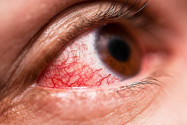 Maharashtra eye infection Conjunctivitis patient found nearly 4 lakhs in Maharashtra State said Health Department Conjunctivitis Eye Infection : राज्यात डोळ्यांचा संसर्ग बळावला, गुरुवारपर्यंत जवळपास 4 लाख बाधितांची नोंद