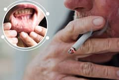 Oral Cancer: 'अशी' असतात तोंडाच्या कॅन्सरची सुरुवातीची लक्षणं; ठरू शकतो घातक