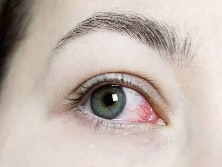 सावधान ! आंखों की रोशनी छीन सकती है EYE FLU में की गई आपकी ये एक गलती