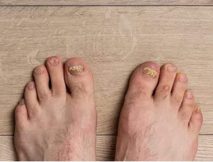 how to prevent fungal infection during monsoon क्या मानसून में आपके पैरों का भी हो जाता है इतना बुरा हाल...यहां जानें कैसे करना है बचाव
