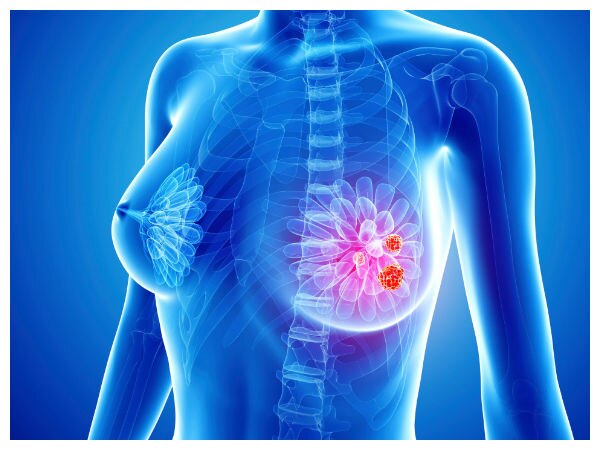 Breast Cancer: மார்பகங்களில் புற்றுநோய் கட்டிகள்.. பரிசோதனை மற்றும் சிகிச்சை முறை.. செய்ய வேண்டியது என்ன?