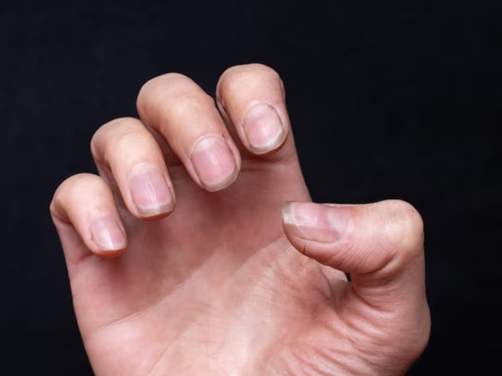 Zinc Deficiency Can Cause White Spots On Nails, White Spots On Nails  Causes, Nakhoon Par Safed Nishan Kyu Dikhte Hain - इस वजह से नाखूनों पर  दिखने लगते हैं सफेद निशान, जानिए