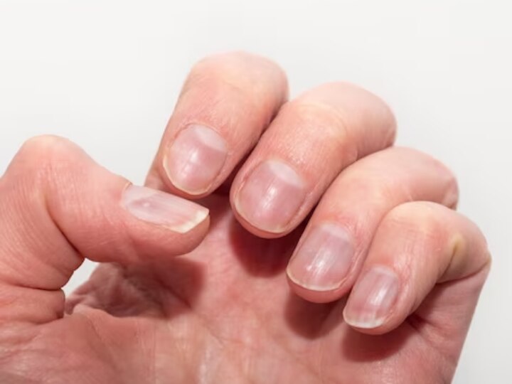 Ridges in Fingernails: Causes and Treatments - Riverchase Dermatology