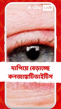 দাপিয়ে বেড়াচ্ছে কনজাঙ্কটিভাইটিস বা আই ফ্লু