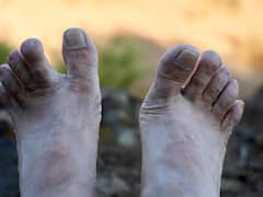 Psoriatic Arthritis: Symptoms, Causes And All That You Need To Know