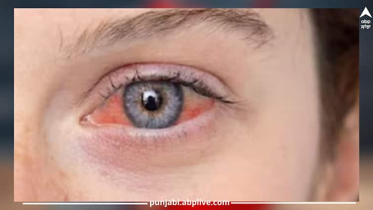 Eye flu patients should not forget these 4 mistakes, otherwise the eyesight will be affected Eye Flu: ਅੱਖਾਂ ਦੇ ਫਲੂ ਦੇ ਰੋਗੀਆਂ ਨੂੰ ਭੁੱਲ ਕੇ ਇਹ 4 ਗਲਤੀਆਂ ਨਹੀਂ ਕਰਨੀਆਂ ਚਾਹੀਦੀਆਂ, ਨਹੀਂ ਤਾਂ ਜਾ ਸਕਦੀ ਅੱਖਾਂ ਦੀ ਰੌਸ਼ਨੀ