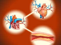 आपके आर्टरी में जमा हो सकता है कैल्शियम...हो सकती है गंभीर बीमारी, जानिए इसके वार्निंग साइन