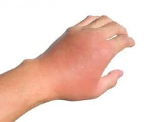 क्या होता है इन्फ्लेमेशन जिससे शरीर में होने लगती है जलन और सूजन, इन लक्षणों से करें पता