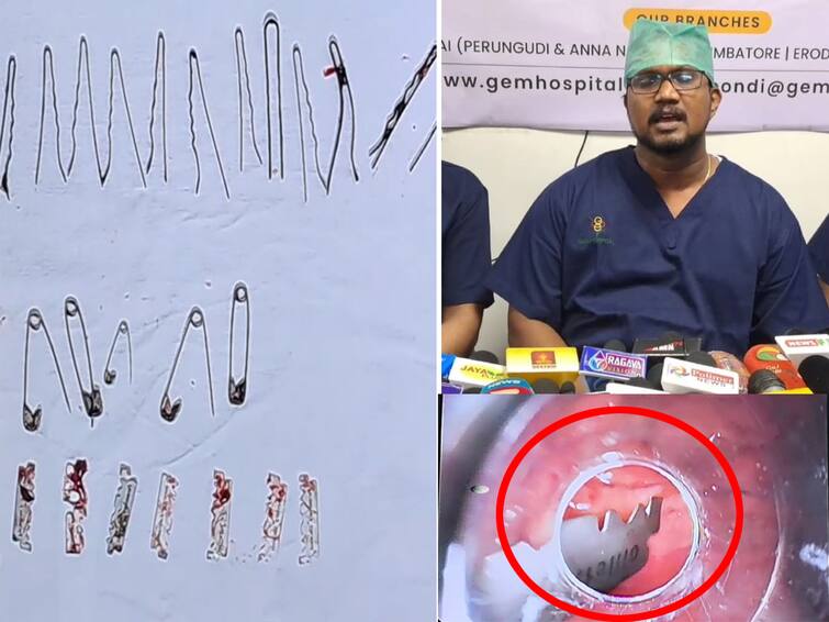 Removal of hairpin blade spurs endoscopy instrument from stomach of mentally challenged youth in Puducherry TNN இளைஞர் வயிற்றில் இருந்து ஹேர்பின், பிளேடு, ஊக்குகள் அகற்றம் -  புதுச்சேரி மருத்துவர்கள் சாதனை