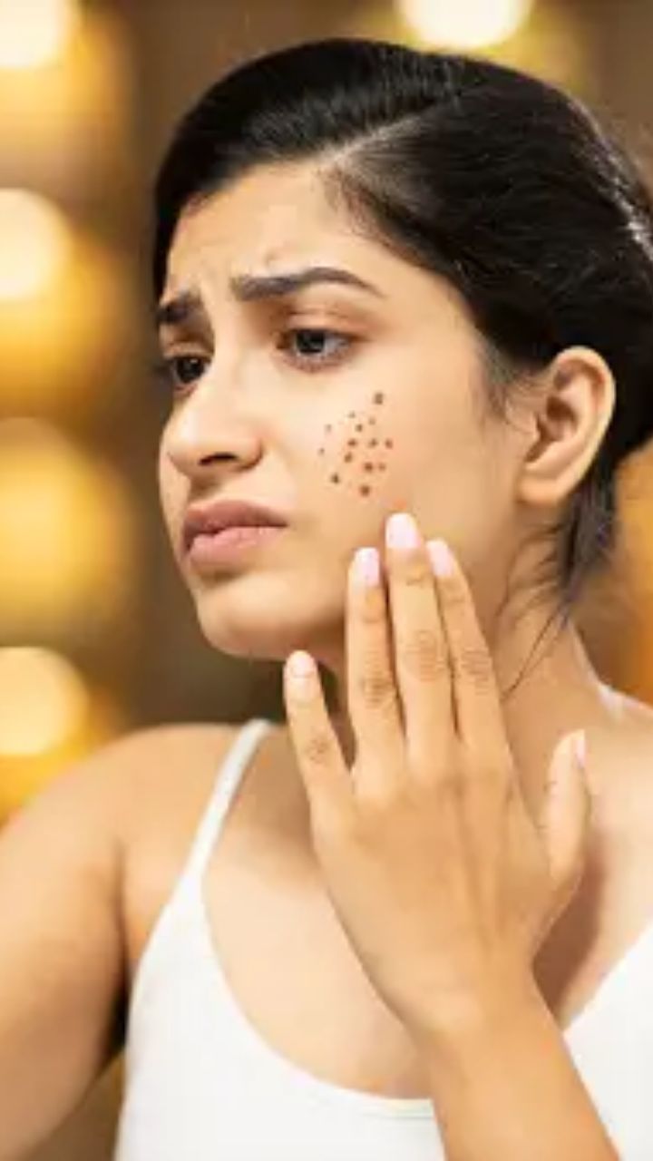 முகப்பருக்கள் வருவது சகஜம்தான்