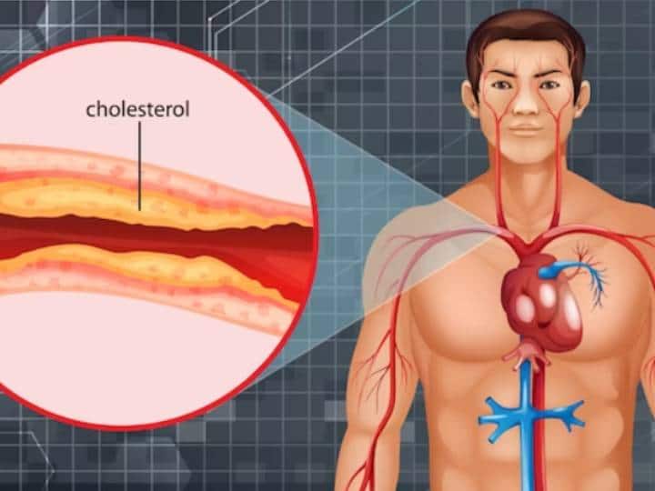 High Cholesterol: शरीर में बढ़ा हुआ है कोलेस्ट्रॉल, यह हैं शुरुआती लक्षण... इन 5 संकतों को न करें इग्नोर