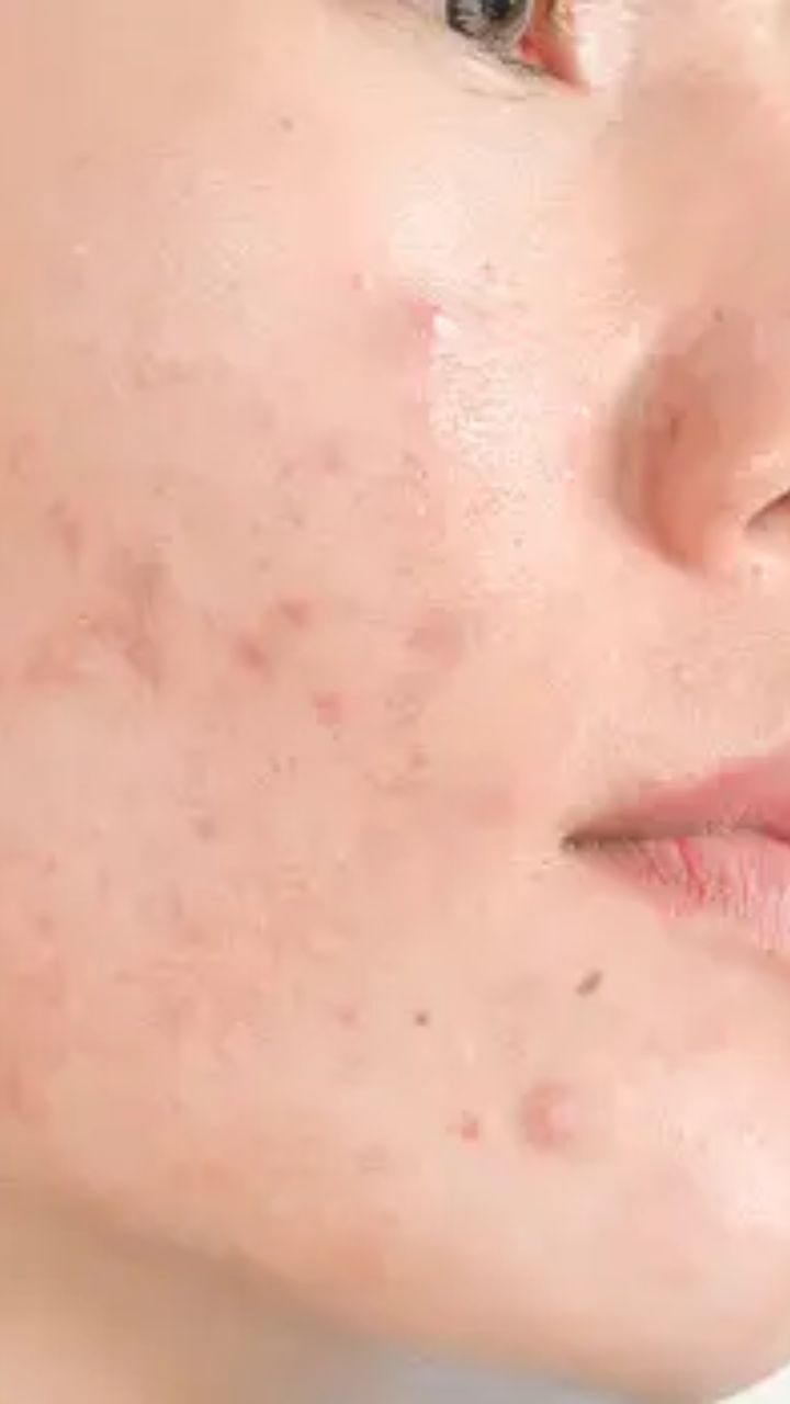 முகப்பருவில் கைப்பட்டால் பருக்கள் அதிகரிக்குமா?