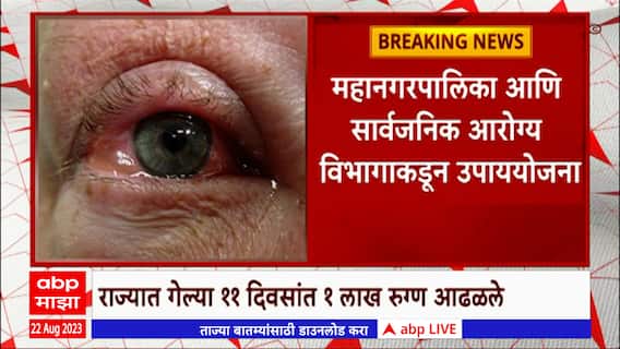Eye Conjunctivitis : राज्यात डोळ्यांच्या साथीचं थैमान, जाणून घ्या तुमच्या जिल्ह्यातील रुग्णसंख्या ABP Majha