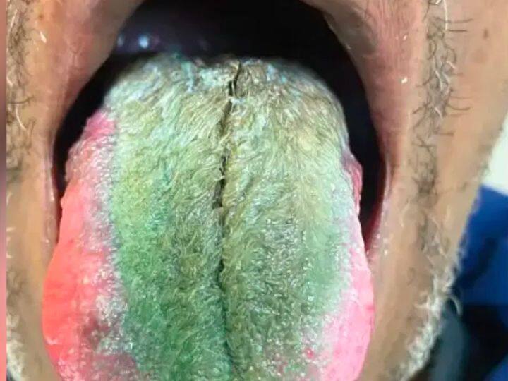 Cigarette smokers should be careful if you get this disease your tongue will turn green खतरनाक है ये बीमारी... जीभ पर बाल उग जाएंगे और रंग हो जाएगा हरा! सिगरेट पाने वालों का है ज्यादा खतरा