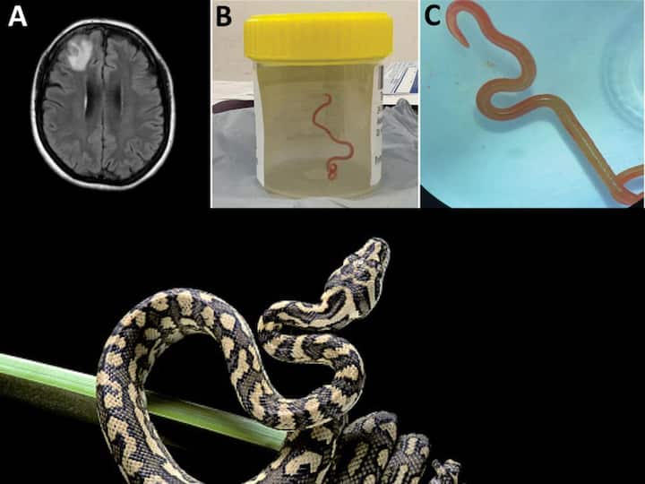 Python parasite pulled from Australian woman's brain - Australian Geographic