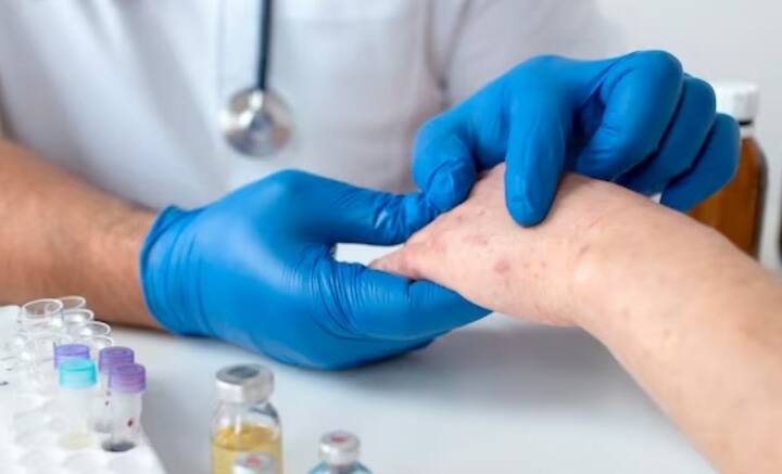 সময়ের সঙ্গে ত্বকের ক্যানসারও বেড়ে চলেছে লাগাতার। ত্বকের কোষগুলির অস্বাভআবিক বৃদ্ধি ঘটলে, তা অনেক সময় ক্যানসারে পরিণত হয়। ত্বকের বাইরের আবরণই সাধারণত থাবা বসায় ক্যানসার। তবে ত্বকের ক্যানসারও বিভিন্ন প্রকারের হয়।