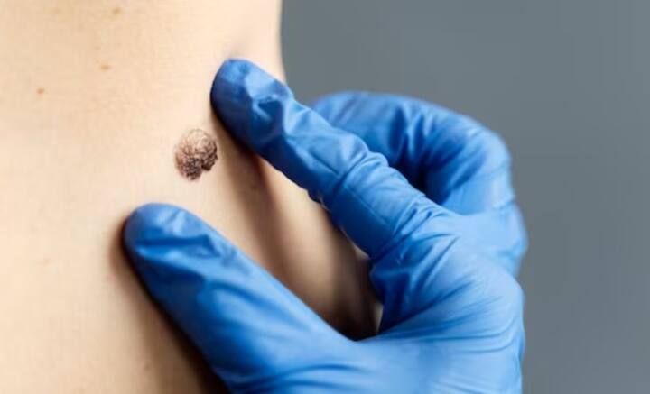 মূলত অতি বেগুনি রশ্মি থেকে নির্গত বিকিরণ থেকে ত্বকের ক্যানসার হয়। সূর্যের আলো থেকে নির্গত অতি বেগুনি রশ্মি বা কৃত্রিম ট্যানিং যন্ত্র থেকে নির্গত অতি বেগুনি রশ্মি থেকেও ত্বকের ক্ষতি হতে পারে। তবে ত্বকের ক্যানসারের ঝুঁকি এড়ানো যায় একটু সতর্ক হলেই।