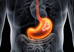 Gastric Cancer : ਇਸ ਕੈਂਸਰ ਤੋਂ ਸਾਵਧਾਨ ਰਹਿਣ ਔਰਤਾਂ, ਜਾਣੋ ਕਿਉਂ ਹੈ ਇੰਨਾਂ ਖ਼ਤਰਨਾਕ