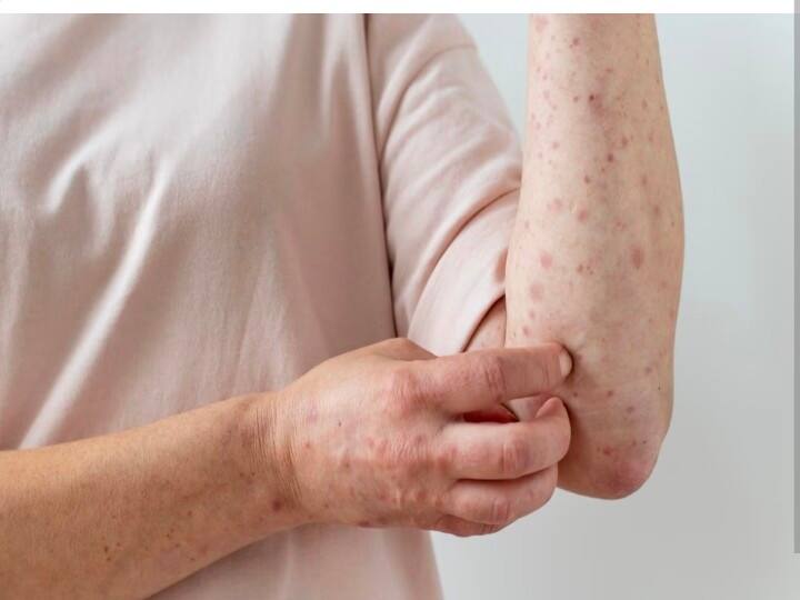 scientist found new variant of chickenpox in india know clad 9 symptoms and how to prevent it भारत में मिला चिकनपॉक्स का नया वेरिएंट, बचना है तो पहचान लीजिए ये लक्षण