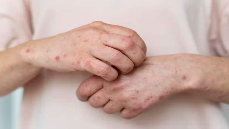 Scientist Found New Variant Of Chikenpox In India know In Detail About Clad 9 Its Sympots And How To Prevent It Know In Detail Marathi News Chickenpox New Variant : भारतात आढळला कांजण्याचा नवा व्हेरिएंट , 'ही' आहेत लक्षणं