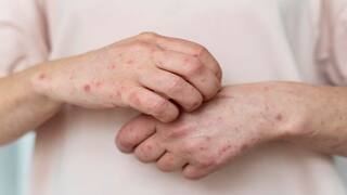Chickenpox New Variant : भारतात आढळला कांजण्याचा नवा व्हेरिएंट , 'ही' आहेत लक्षणं