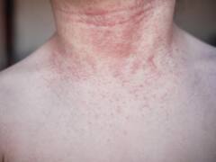 World Atopic Eczema Day 2023: Causes, Symptoms And Home Remedies To Cure The Problem