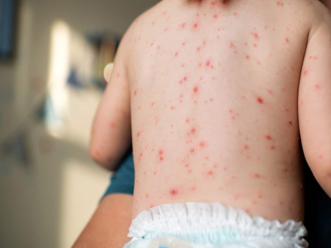 New Chickenpox Virus Variant Detected In India, Know All About 'Clade 9' New Chickenpox Virus Variant Detected In India, Know All About 'Clade 9' New Chickenpox Virus Variant Detected In India, Know All About 'Clade 9'