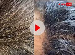Viral Video : ਬੱਚੀ ਦੇ ਵਾਲਾਂ 'ਚ ਰੇਂਗਦੀਆਂ ਨਜ਼ਰ ਆਈਆਂ ਲੱਖਾਂ ਜੂੰਆਂ ਤੇ ਲੀਖਾਂ ਨਾਲ ਪੂਰਾ ਸਿਰ, Vidoe ਵੇਖ ਕੇ ਹੋ ਉੱਡ ਜਾਣਗੇ ਹੋਸ਼