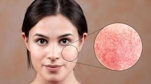 Health: Do not ignore this recurring skin problem, these are symptoms of a serious disease. Health: Do not ignore this recurring skin problem, these are symptoms of a serious disease.