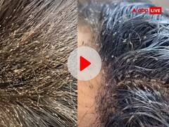 बच्ची के बालों में रेंगते दिखे लाखों जूं, लीखों से भरा नजर आया पूरा सिर, VIDEO देख उड़ जाएंगे आपके होश