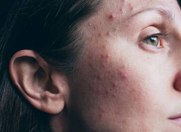 दिवसातून एक-दोन वेळा चेहरा गार पाण्याने धुतल्यास देखील पिंपल्स कमी होऊ शकतात.