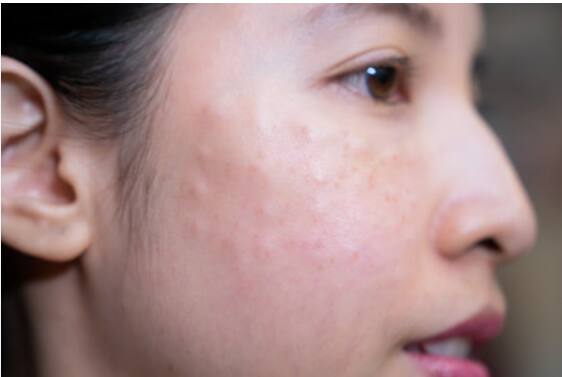 पुष्कळ वेळा अति ताणतणाव देखील पिंपल्सकरता कारणीभूत असतात.