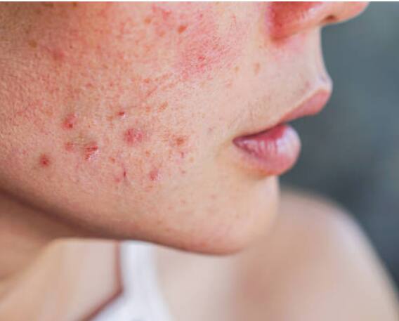 पिंपल्स घालवण्याकरता हळदीचा वापर करा.