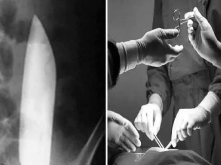 Doctors found a 15cm knife in a man stomach in Nepal Knife In Stomach: పొట్టలో 15 సెం.మీ పొడవైన కత్తి, ఎక్స్ - రే చూసి వైద్యులు షాక్