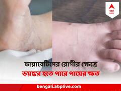Diabetes : ডায়াবেটিস হলে পা হতে পারে অসাড় ! ভয়ঙ্কর হতে পারে ক্ষত, কীভাবে সাবধান হবেন ডায়াবেটিক ফুট থেকে?