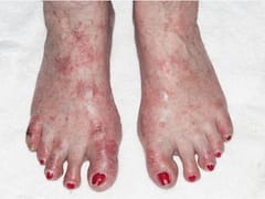 Atopic Dermatitis: What Causes This Eczema Subtype? Know How It Affects Mental Health