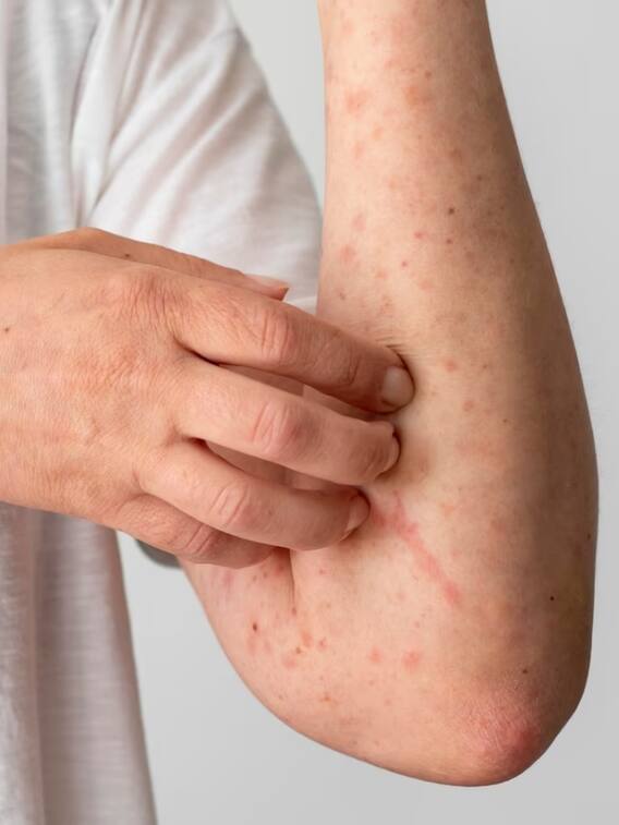 चिकन पॉक्स होने पर करें इन चीजों से परहेज