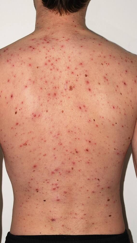 ਚਿਕਨਪੋਕਸ ਨੂੰ ਮਾਤਾ ਕਿਉਂ ਕਹਿੰਦੇ ਹਨ?