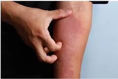 Home Remedies for Itching : सतत अंग खाजवत आहे? 'हे' घरगुती उपाय पडतील कामी