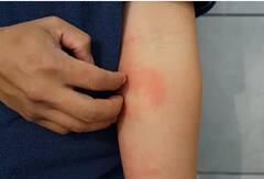 Home Remedies for Itching : सतत अंग खाजवत आहे? 'हे' घरगुती उपाय पडतील कामी