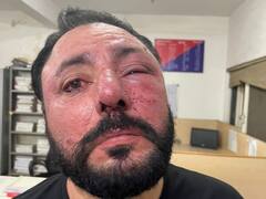 गुरुग्राम के पब में बाउंसरों की गुंडागर्दी, NRI और उसकी महिला मित्र से मारपीट, जानें पूरा मामला