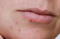 Causes of Pimples: સવારે આ ભૂલ કરશો તો વધુ થશે ખીલ, જાણો કઇ મોર્નિગ હેબિટ્સ બગાડે છે સ્કિન