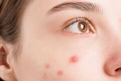 Causes of Pimples: સવારે આ ભૂલ કરશો તો વધુ થશે ખીલ, જાણો કઇ મોર્નિગ હેબિટ્સ બગાડે છે સ્કિન