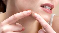 Causes of Pimples: સવારે આ ભૂલ કરશો તો વધુ થશે ખીલ, જાણો કઇ મોર્નિગ હેબિટ્સ બગાડે છે સ્કિન