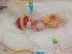 4 महीने की प्रेग्नेंसी के बाद ही पैदा हो गई बच्ची, 328 ग्राम है वजन! पैरेंट्स का देखकर फटा कलेजा